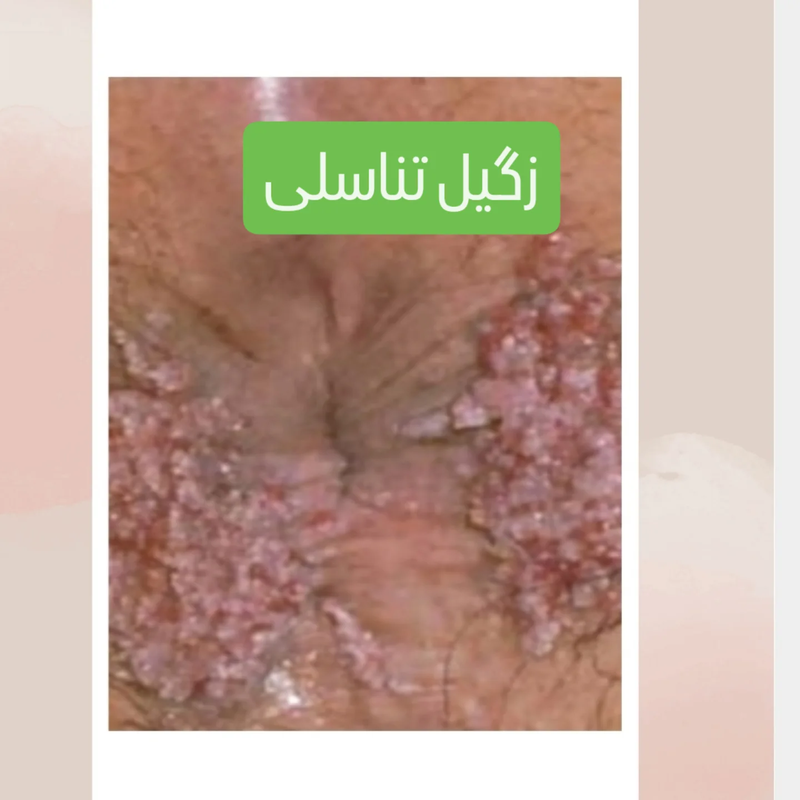 آنال، عوارض و خطرات مختلف برای سلامتی