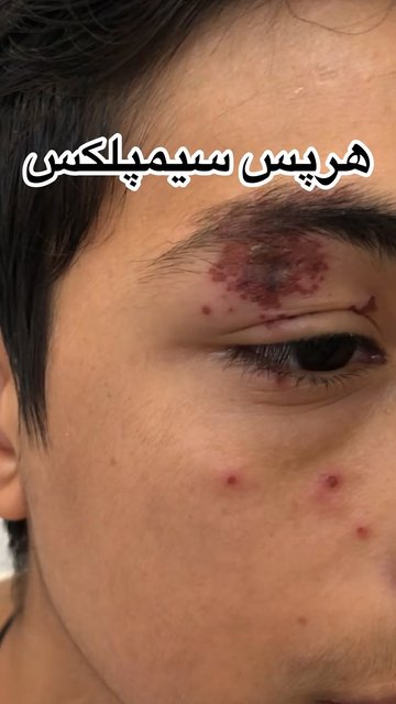 هرپس سیمپلکس نوع ۱، التهاب پلک حاد