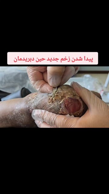 مراقبت دقیق از حاشیه زخم ضروری است