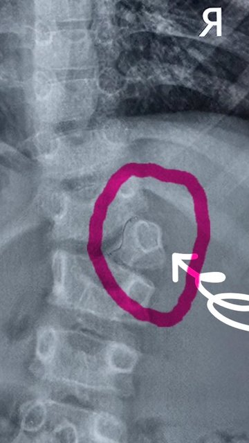 جراحی موفق باهمکاری تیم بیهوشی و جراحی