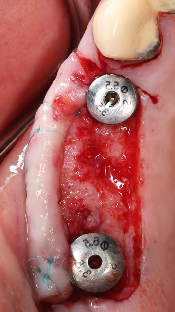 Dentis Implant Uncovery Surgical Procedure