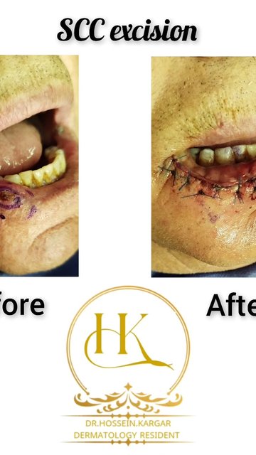 پیشگیری و تشخیص زودرس سرطان سلول سنگفرشی پوست