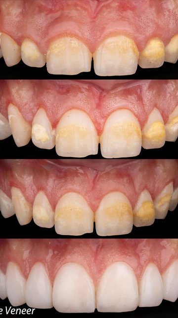 جراحی جهت افزایش طول تاج و ونیر
