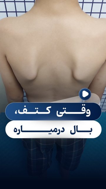 کتف بالدار در بچه ها، علائم، اثرات و راه های درمان