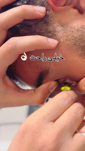 لنز اسکلرال، معجزه ای برای بینایی شما