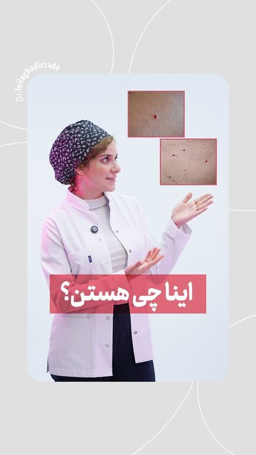 خال گیلاسی، نماد زیبایی و جذابیت