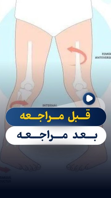 کفی یا وسایل اصلاحی برای کجی پا