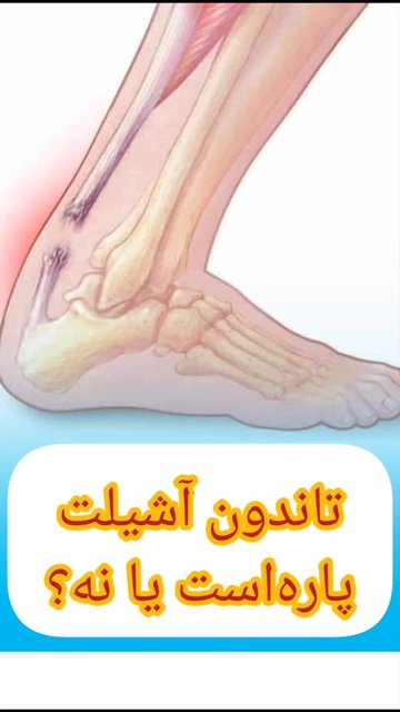 آموزش تست thompson برای پارگی آشیل پا