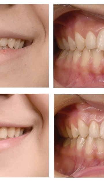 ارتودنسی کوتاه مدت برای اصلاح قوس لبخند