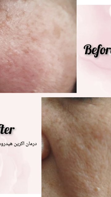 اکرین هیدروسیستوما، ضایعه پوستی با رنگ آبی و همراهی علائم خاص