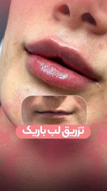 زیبایی لب های Inverted lips با تزریق فیلر