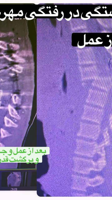 با جراحی دقیق، نوجوان ۱۵ ساله بهبود یافته است