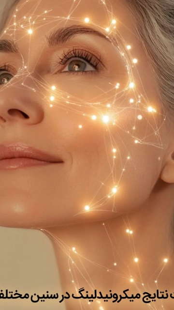 جوان سازی پوست با میکرونیدلینگ، مزایایی که نباید از دست بدهید