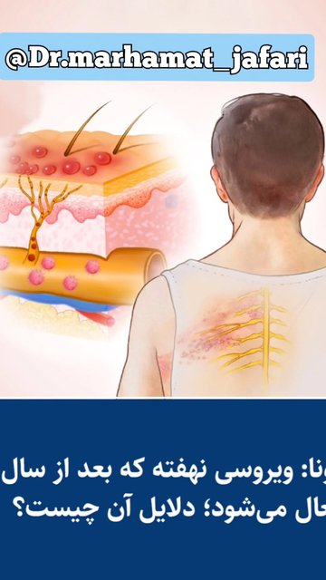زونا، ویروس نهفته با علائم و عوارض زمان گرا
