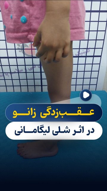 آسیب زدگی رباط زانو اهمیت دارد