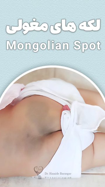 لکه مغولی، نشانه ای شایع در نوزادان