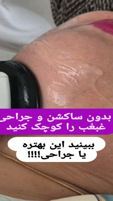 درمان غبغب با ایمپریوم مد ۴۰۰، آیا نتیجه استفاده از آن مطمئن است؟