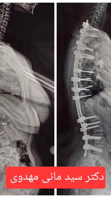 درمان کیفوز کانژنیتال ستون فقرات با جراحی