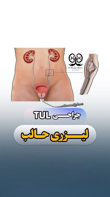 جراحی لیزری حالب توسط دکتر مصطفی حاتمی