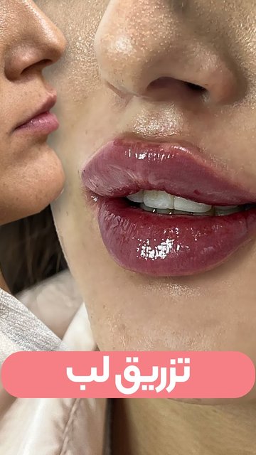 تزریق لب نیچرال؛ برجسته سازی طبیعی و زیبا