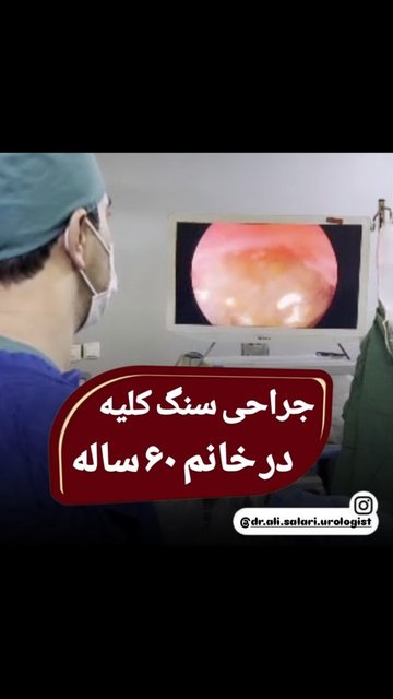 عمل سنگ کلیه با لیزر در بم