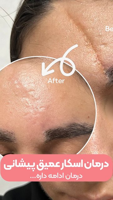 درمان اسکار، از چالش تا نتیجه