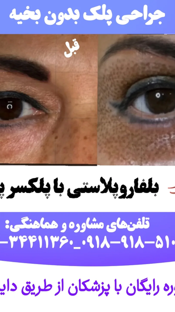 بلفاروپلاستی، روش جدید اصلاح چین و چروک های چشم