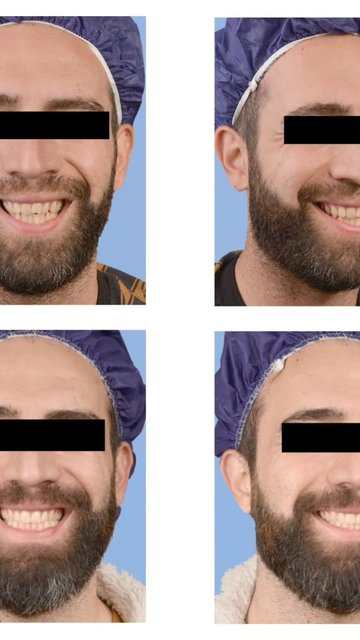 ارتودنسی ثابت، بدون کشیدن دندان، بدون ایمپلنت.