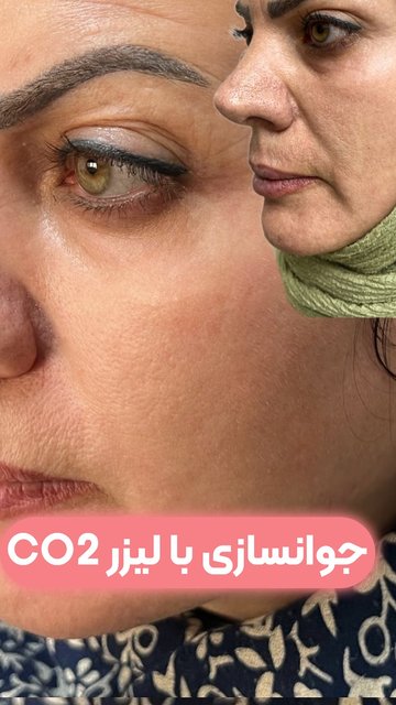 لیزر CO2 برای جوانی و روشن تر شدن پوست