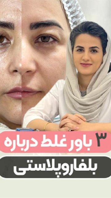 باورهای اشتباه درباره بلفاروپلاستی، حقایق و اطلاعات