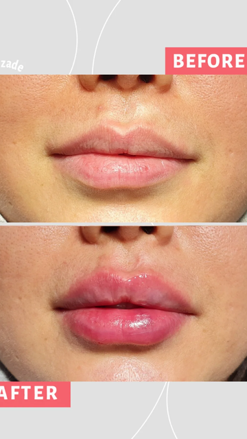 زیبایی با نیم سی سی فیلر، راهکار جذاب و موثر