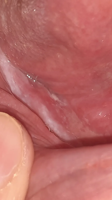 مشکل دیابتی، درد لثه، وضعیت سفیددهن در خانم ۵۷ ساله